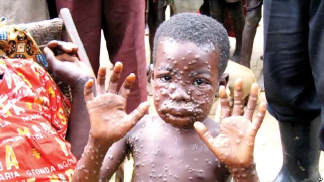 Mpox virus is spreading at an alarming rate in Africa